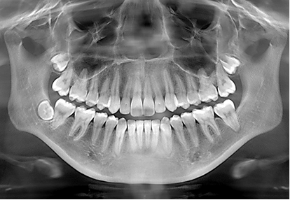 maharjan local denture new dental 01